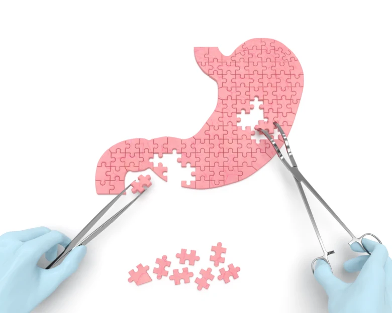 Ruce v rukavicích s chirurgickými nástroji skládají puzzle ve tvaru žaludku