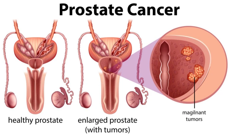 Ilustrace zdravého a nádorově poškozeného prostatu